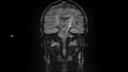 T2 HASTE Diff COR-MAGNETOM Sola/Coil-HeadNeck 20/Resolution-384/Scan Time-5:33
