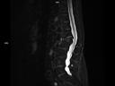 Sagittal T2 Dixon-MAGNETOM Lumina/Coil-Spine 24/Resolution-512/Scan Time-2:25