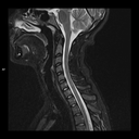 Sagittal STIR-MAGNETOM Free.Max/Coil-HN12/Resolution-512/Scan Time-4:34