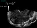 ACUSON P300 Ultrasound System - OB/GYN - Endovaginal Inhomogeneous Uterus