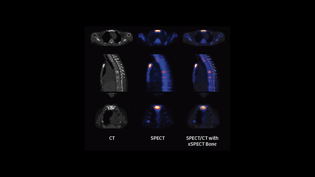 99mTc MDP SPECT/CT imaging in diagnosing Erdheim-Chester disease