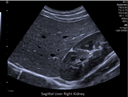 Sagittal-liver-right-kidney