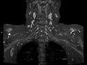 Coronal 3D SPACE IR-MAGNETOM Altea