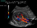 ACUSON P300 Ultrasound System - Abdominal - Renal Vasculature - Color Doppler