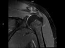 Coronal PD FS-MAGNETOM Lumina/Coil-Shoulder Shape 16/Resolution-320/Scan Time-3:24