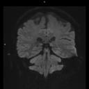 Coronal RESOLVE DWI_b-1000-MAGNETOM Vida/Coil-Head Neck 20/Resolution-1.5mm slice/Aceleration-p2