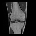 Coronal T1-MAGNETOM Free.Max/Coil-Contour Small/Resolution-512/Scan Time-3:15/Aceleration-DRS