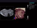 3D imaging of intrauterine device