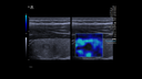 2D SWE Thyroid Mass Displacement Map