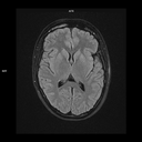 Axial FLAIR-MAGNETOM Free.Max/Coil-HN12/Resolution-512/Scan Time-4:00/Aceleration-p2 DRS