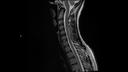 T2 TSE SAG-MAGNETOM Sola/Coil-HeadNeck 20/Resolution-448/Scan Time-2:36/Aceleration-p2