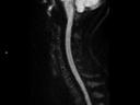 Sagittal RESOLVE Diffusion-MAGNETOM Lumina/Coil-HeadNeck 20/Spine 24/Resolution-160/Scan Time-2:50