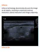 InFocus-Ultrasound