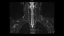 T2 TSE Dixon COR-MAGNETOM Sola/Coil-HeadNeck 20/Resolution-368/Scan Time-3:24