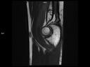 Sagittal T2 TSE-MAGNETOM Lumina<br />