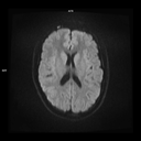 Axial Diffusion-MAGNETOM Free.Max/Coil-HN12/Resolution-320/Scan Time-3:20/Aceleration-p2