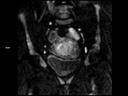 Coronal RESOLVE Diffusion-MAGNETOM Lumina/Coil-Body 12/Spine 24/Resolution-112/Scan Time-3:48/Aceleration-p2