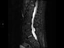 Sagittal T2 STIR-MAGNETOM Lumina/Coil-Spine 24/Resolution-320/Scan Time-3:08/Aceleration-p2