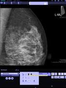 syngo.Breast Care