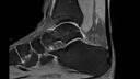 Sagittal PD FS DR Sharp-MAGNETOM Vida/Coil-Foot Ankle 16/Resolution-992/Scan Time-3:26/Aceleration-p2