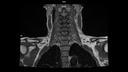 T1 TSE COR-MAGNETOM Sola/Coil-HeadNeck 20/Resolution-432/Scan Time-3:27/Aceleration-p2