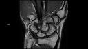 Coronal PD DR Sharp-MAGNETOM Lumina/Coil-Special Purpose/Resolution-448/Scan Time-2:22