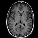 Axial T1 FLAIR-MAGNETOM Vida/Coil-Head Neck 20/Resolution-320/Scan Time-0:50/Aceleration-p2