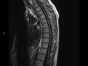 Sagittal T1 FLAIR-MAGNETOM Lumina/Coil-Spine 24/Resolution-320/Scan Time-3:42