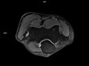 Axial PD FS-MAGNETOM Lumina/Coil-UltraFlex 18 Small/Resolution-320/Scan Time-2:12/Aceleration-p2