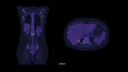 Biograph Vision clinical case