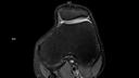 Axial PD FS DR Sharp-MAGNETOM Vida/Coil-Knee 18/Resolution-672/Scan Time-1:21/Aceleration-p3