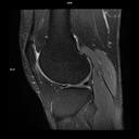 Sagittal PD TSE -MAGNETOM Altea/Coil-Knee18/Resolution-608/Scan Time-0:39/Aceleration-s2