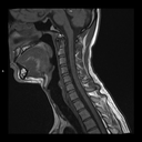Sagittal T1-MAGNETOM Free.Max/Coil-HN12/Resolution-320/Aceleration-p2