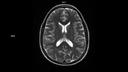 T2 TSE AX-MAGNETOM Sola/Coil-HeadNeck 20/Resolution-256/Scan Time-0:38/Aceleration-p2