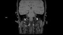 T1 TSE Dixon COR-MAGNETOM Sola/Coil-HeadNeck 20/Resolution-304/Scan Time-3:06