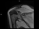 Coronal PD FS-MAGNETOM Lumina<br />
