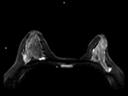 Axial RESOLVE Diffusion-MAGNETOM Lumina/Coil-Sentinelle 16/Resolution-194/Scan Time-3:30