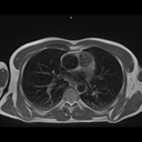 Axial PD-MAGNETOM Free.Max/Coil-BM Contour Large/Spine/Resolution-336/Scan Time-4:18/Aceleration-p2