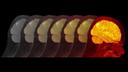 brain scan pet imaging for alzheimers