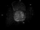 Axial Diffusion-MAGNETOM Lumina/Coil-Body 12/Spine 24/Resolution-228/Scan Time-3:45