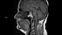 T1 TSE Dixon SAG-MAGNETOM Sola/Coil-HeadNeck 20/Resolution-288/Scan Time-1:24/Aceleration-p2