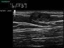 ACUSON P300 Ultrasound System - Breast - Chest Wall Fibroadenoma