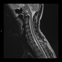 Sagittal T2-MAGNETOM Free.Max/Coil-HN12/Resolution-608/Scan Time-3:39