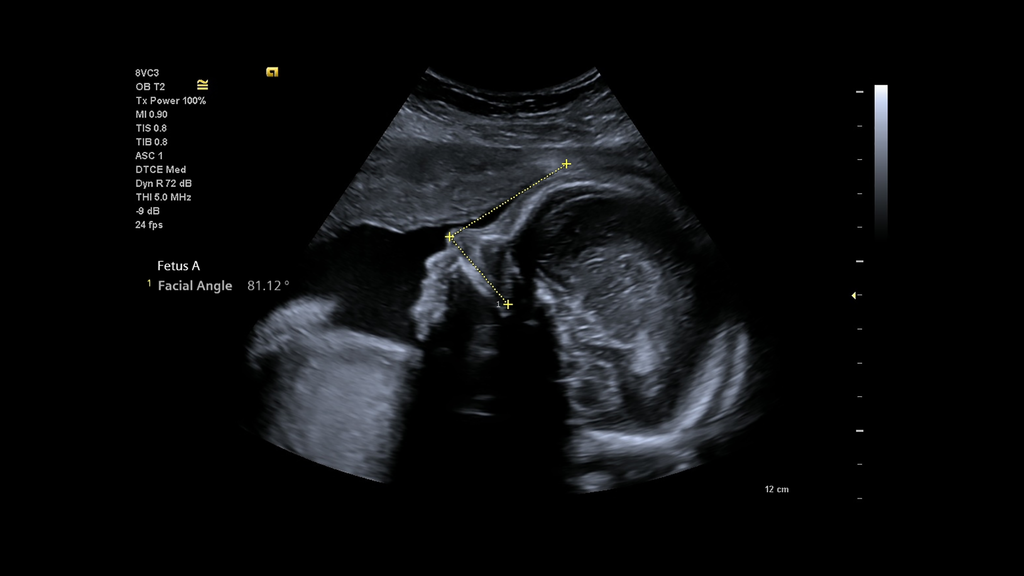 ACUSON Juniper Ultrasound System