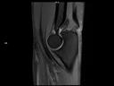Sagittal PD FS-MAGNETOM Lumina/Coil-UltraFlex 18 Small/Resolution-512/Scan Time-3:35/Aceleration-p2