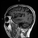 Sagittal T1 FLAIR-MAGNETOM Vida/Coil-Head Neck 64/Resolution-640/Scan Time-1:33