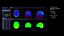 Biograph Vision clinical case