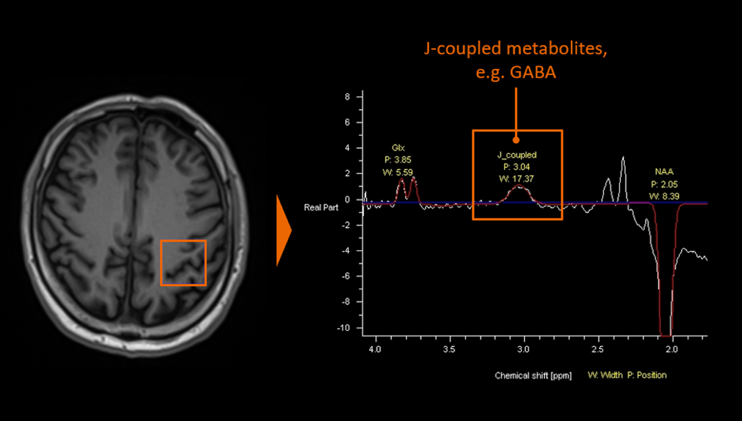 Single Voxel Spectroscopy Edit