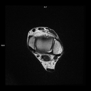 Axial T2-MAGNETOM Free.Max/Coil-Contour Small/Resolution-768/Scan Time-1:59/Aceleration-p2 s2 DRS