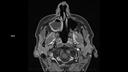 T1 TSE Dixon AX post-MAGNETOM Sola/Coil-HeadNeck 20/Resolution-256/Scan Time-3:42